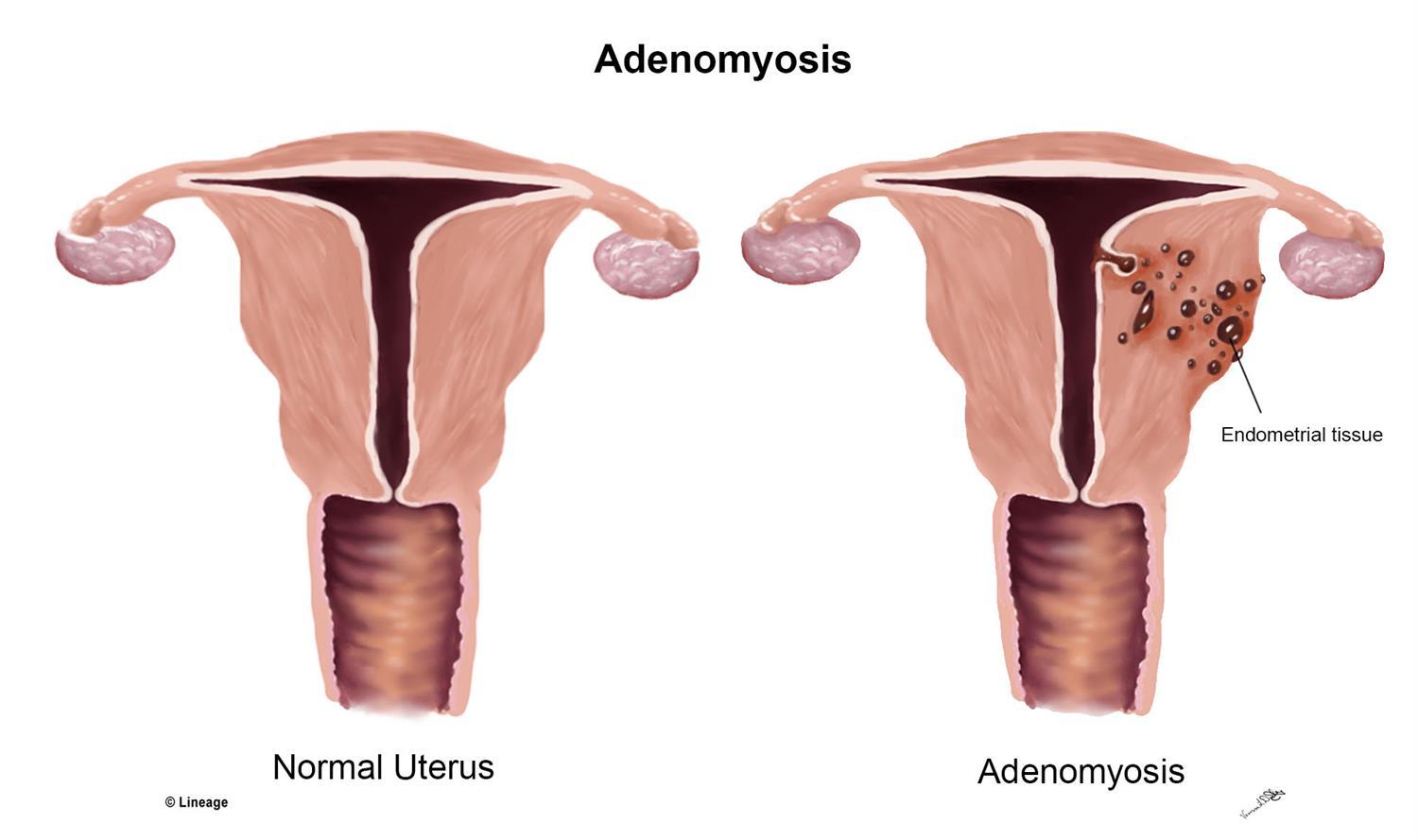 Adenomyosis 1