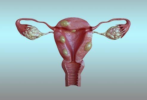 Adenomyosis vs uterine fibroids