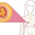 Breast cancer facts what is breast cancer 1