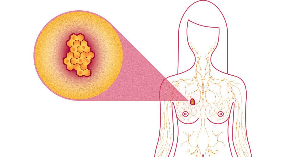 ALL ABOUT BREAST CANCER AND NATURAL CURE