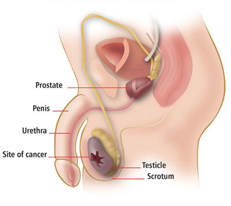 Les étapes du cancer du testicule et du traitement naturel