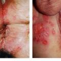Collage herpes anal perianal 1