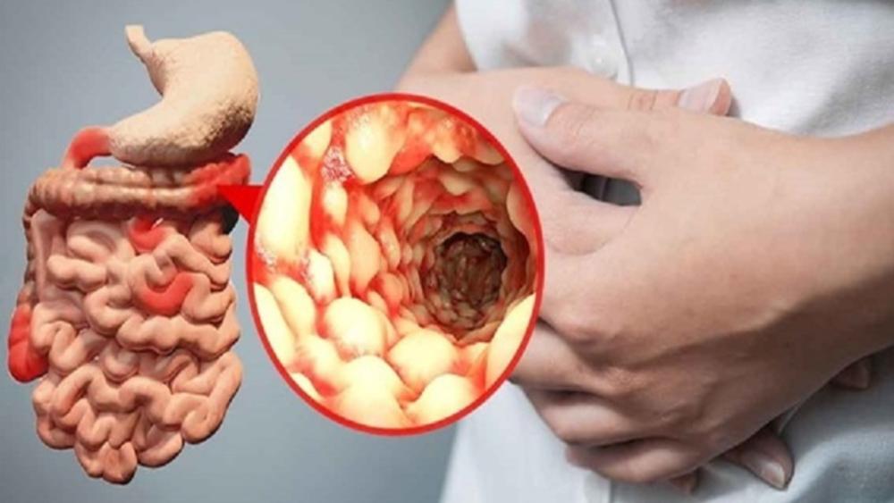 Crohn s disease treatment
