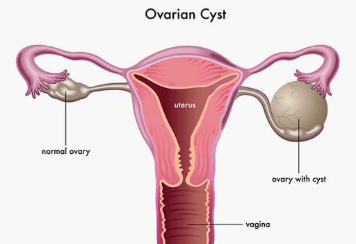 Cyst2