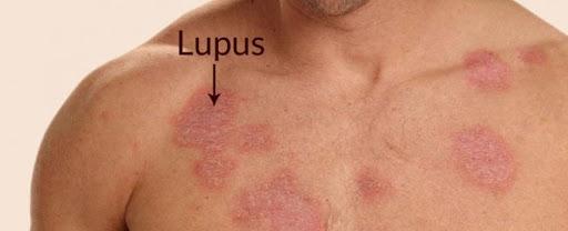 Herbal medicine for lupus