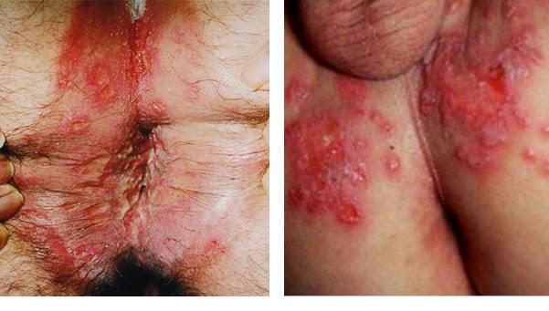 Herpes infection natural treatment
