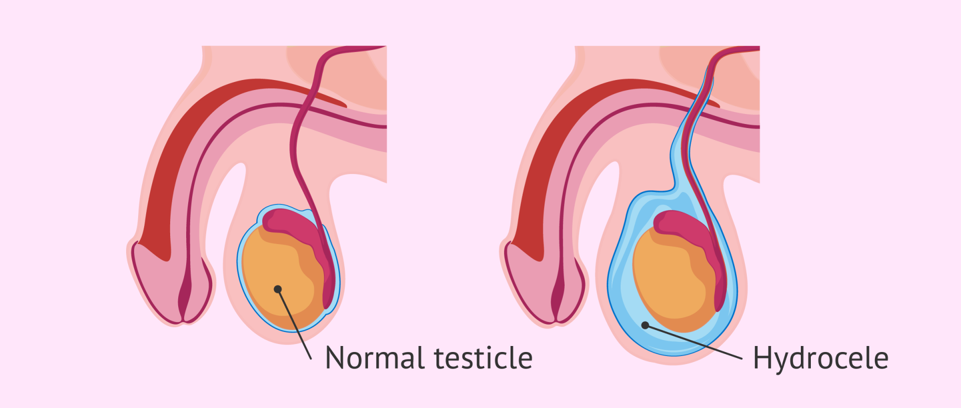 Hydrocele