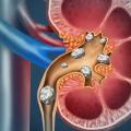 Kidney stones management 1