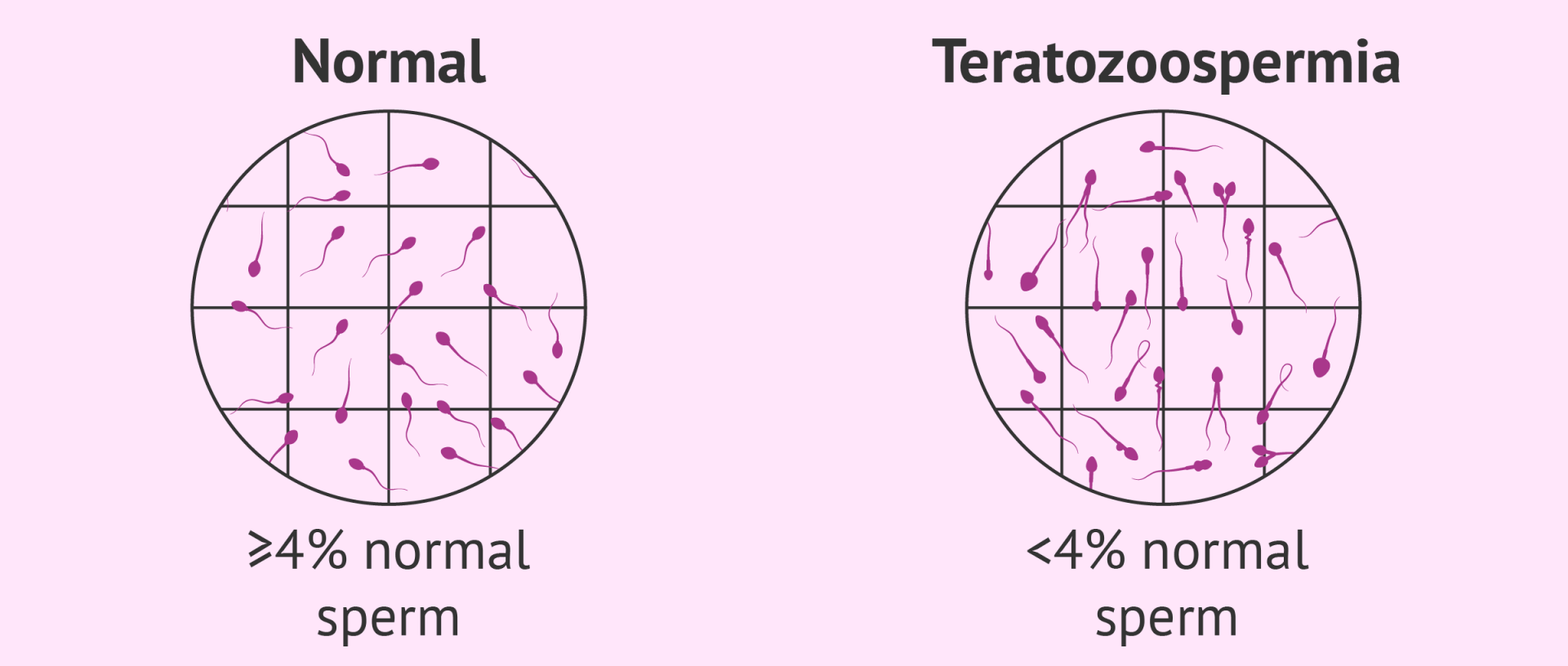 Male sterility due to teratozoospermia