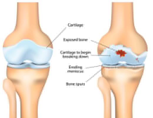 Osteoarthritis