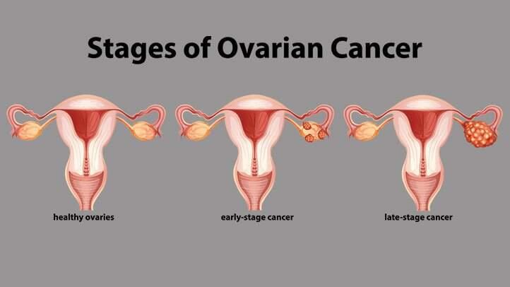 Ovarian cancer stages 722x406