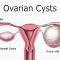 Ovariancyst 1