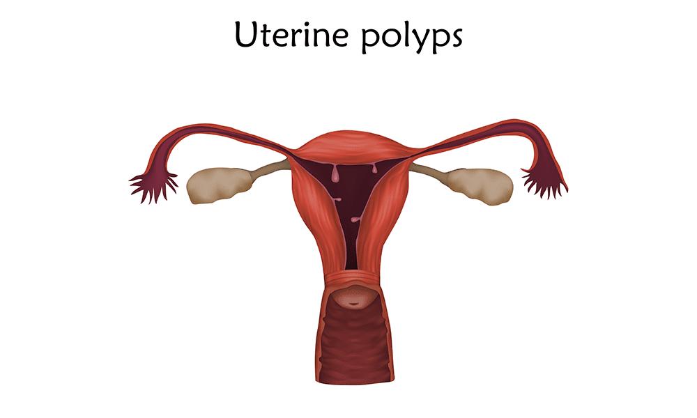 U polyps