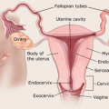 Uterine cancer 1