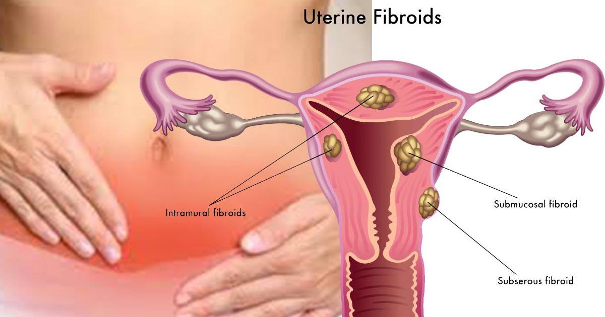 Uterine fibroids fb 1