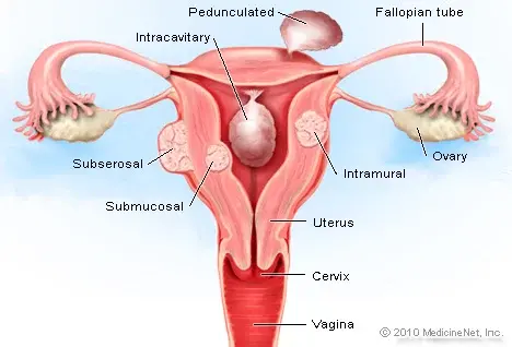 Uterine fibrroid 1