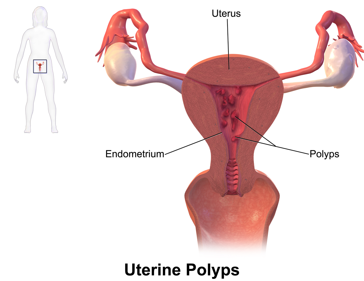 Uterine polyps 4