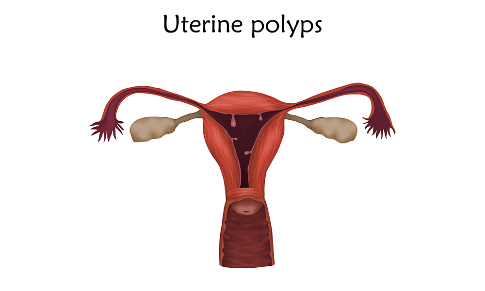 Uterine polyps image